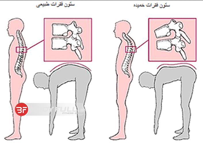 علائم، عوارض و راه های بهبود عارضه پشت گرد
